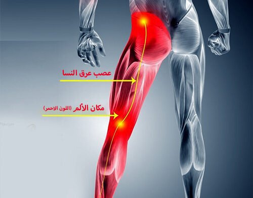 أعراض عرق النسا في الرجل اليسرى