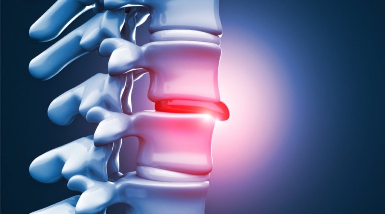 هل عملية الانزلاق الغضروفي خطيره