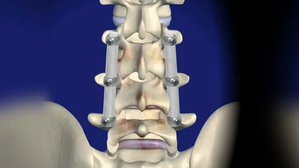 عملية تثبيت الفقرات القطنية بالمنظار في السعودية