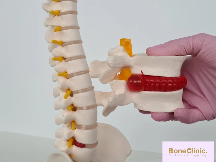 نسبة نجاح عملية غضروف الرقبة وأهم العوامل المؤثرة في نتائجها