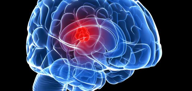 نسبة نجاح عمليات اورام المخ