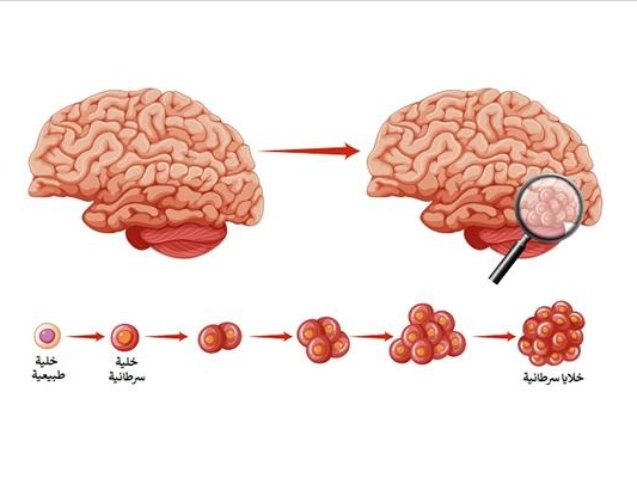أعراض سرطان الدماغ المبكرة