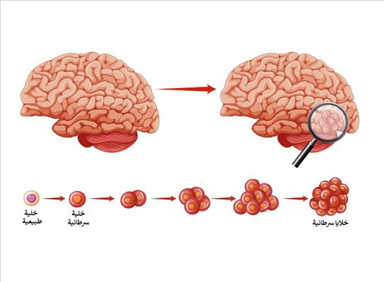 أعراض سرطان الدماغ المبكرة