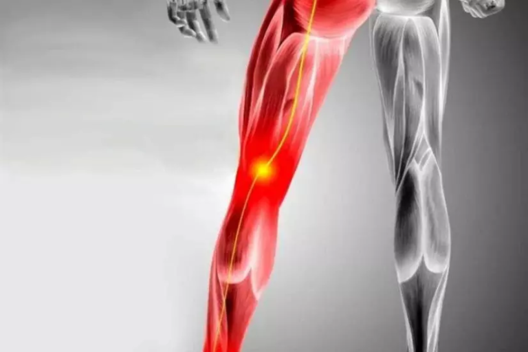 ما هي اعراض سرطان عرق النسا؟