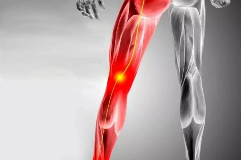 ما هي اعراض سرطان عرق النسا؟
