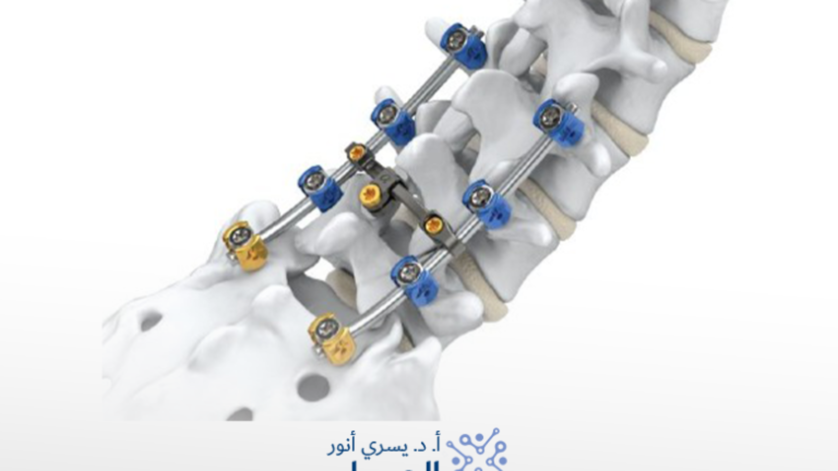 هل عملية فقرات الظهر خطيره
