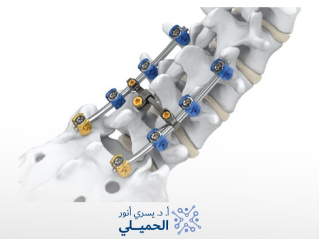 هل عملية فقرات الظهر خطيره
