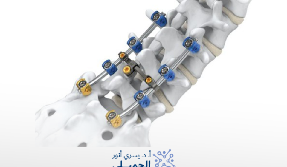 هل عملية فقرات الظهر خطيره
