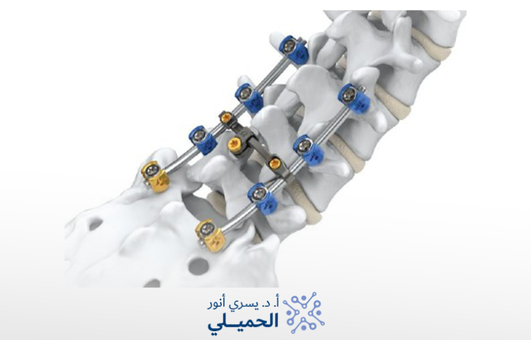 هل عملية فقرات الظهر خطيره